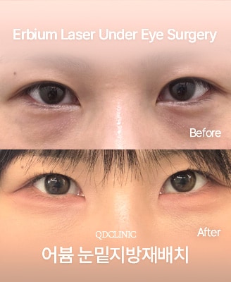 Vorher-Nachher-Fotos: Fettumverteilung unter den Augen mit Erbium-Laser