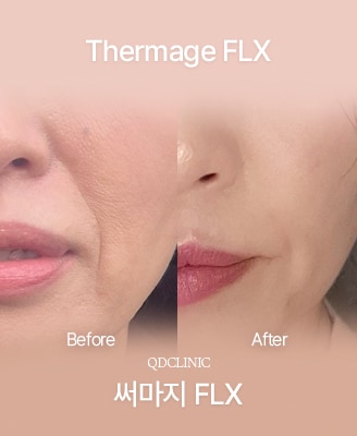 Vorher-Nachher-Fotos: Thermage FLX