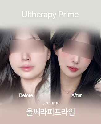 Vorher-Nachher-Fotos: Ultherapy PRIME